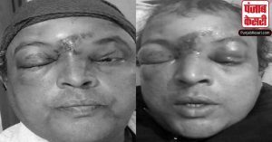 Banka News: बिहार के बांका में नकल रोकने का आदेश दिया तो मजिस्ट्रेट का नाक मुंह तोड़ दिया