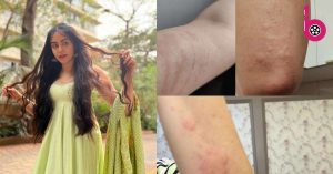 Adah Sharma ने हेल्थ इश्यू की वजह से लिया काम से ब्रेक, सोशल मीडिया पर शेयर की एलर्जी की कई तस्वीरें