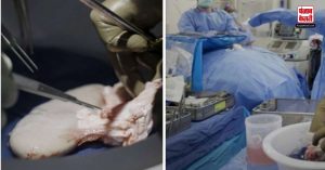 Medical field में बड़ी कामयाबी, Human में लगाई सूअर की किडनी, अभी भी कर रही सही से काम