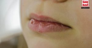 Dry Lips: सर्दियों में फटे होठों को इन उपायों से बनाएं मुलायम