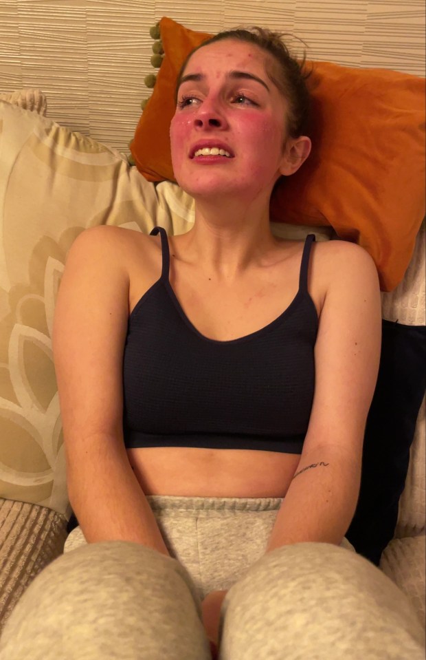Woman allergic to herself 