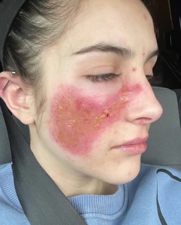 Woman allergic to herself 