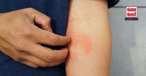 सर्दियों में बढ़ रहा Skin Dermatitis का खतरा, इन बातों का रखें ध्यान