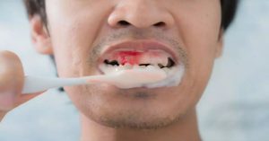 ब्रश करते समय दांतों से खून निकलना हो सकता है हानिकारक!