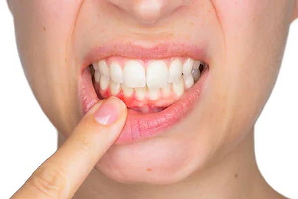 teeth3