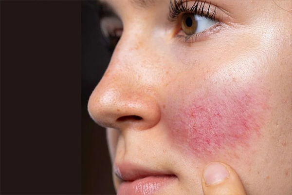 skin6