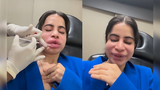 Urfi javed lip fillers 
