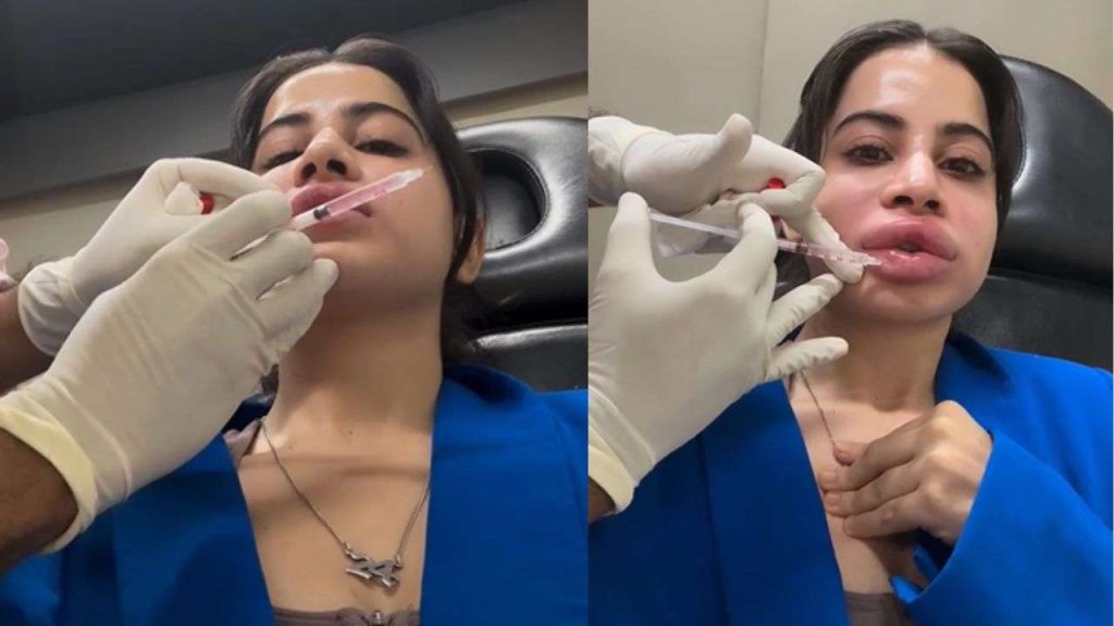 Urfi javed lip fillers 