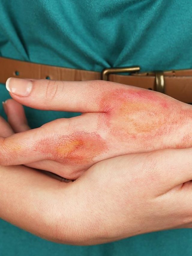 home remedies for burn scars  शरीर से जले का निशान हटाने के घरेलु उपाय