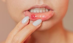 Mouth Ulcers Causes