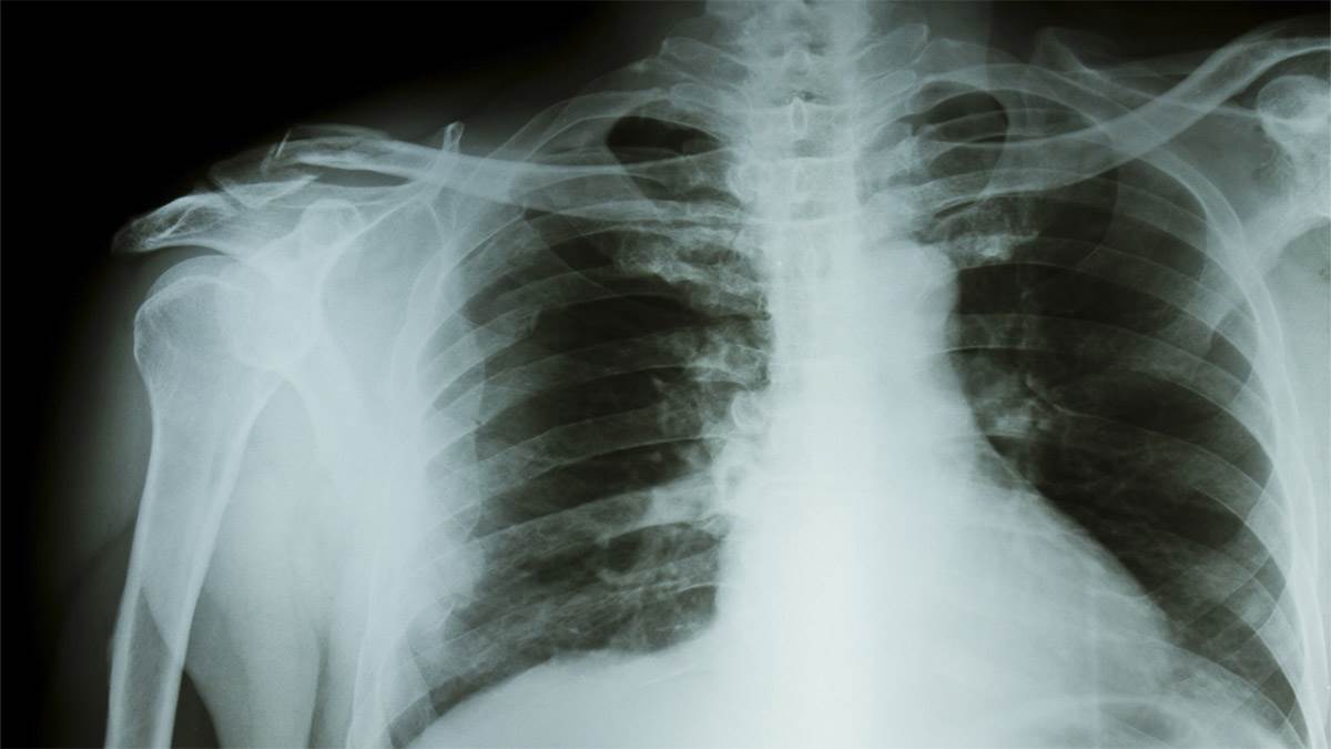 TB Cases in India