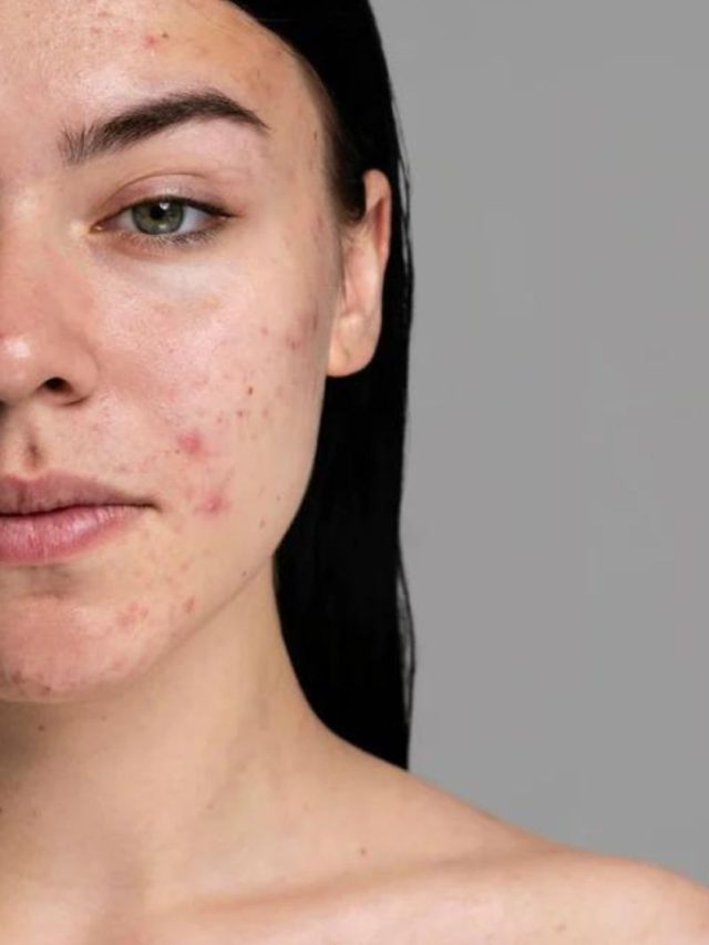 superfoods for acne  एक्ने फ्री स्किन के लिए टॉप 8 आयुर्वेदिक सुपरफूड्स