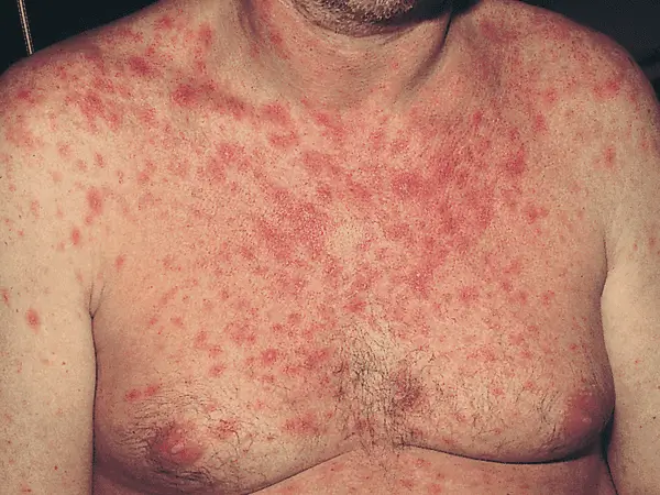 AIDS Diwas Controversy