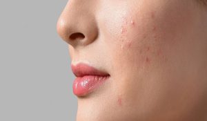 summer acne causes and remedies